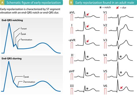 sinus rhythm early repolarization pattern.